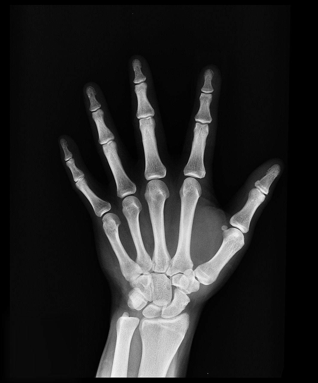 x-ray, medical treatment, arm-1704855.jpg